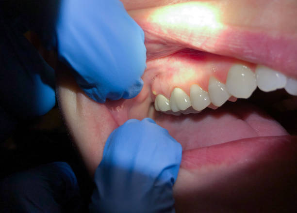 Best Emergency Denture Repair in Pine Beach, NJ
